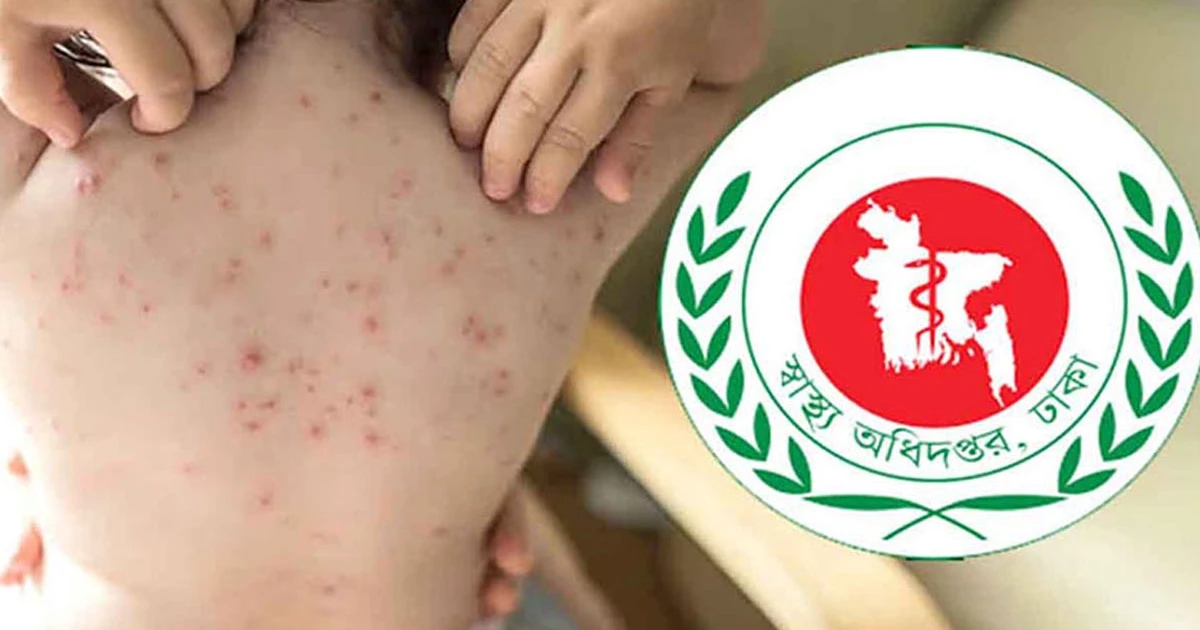 হামের উপসর্গ নিয়ে আরও ১১ জনের মৃত্যু