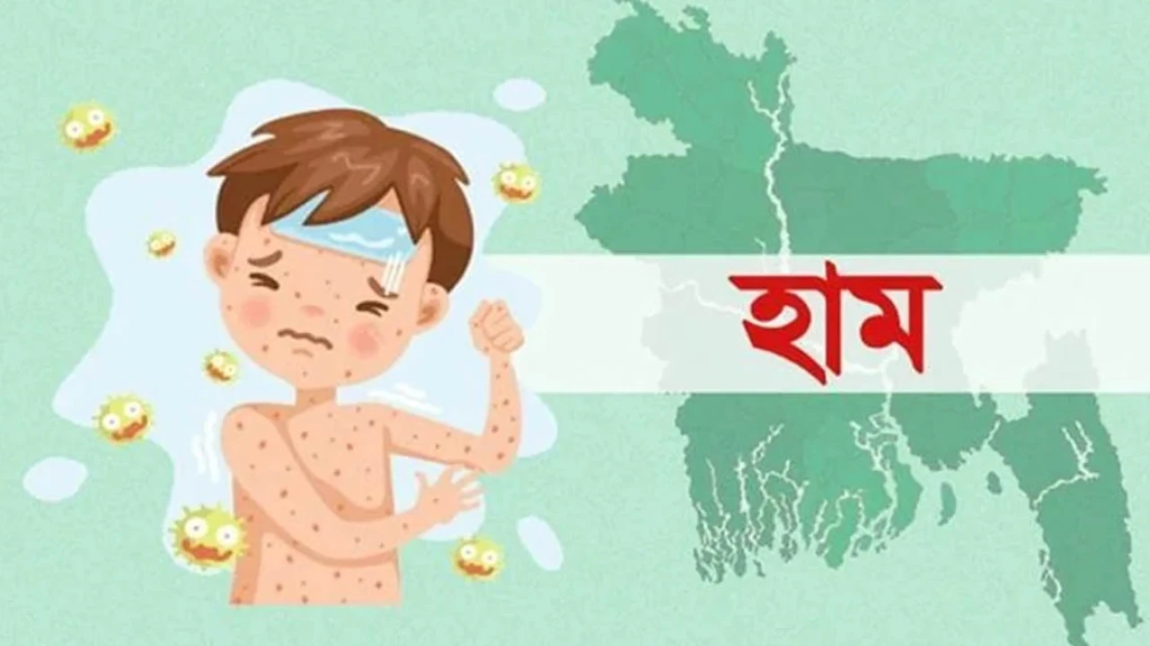 হাম ও হামের উপসর্গে আরও ৫ শিশুর মৃত্যু