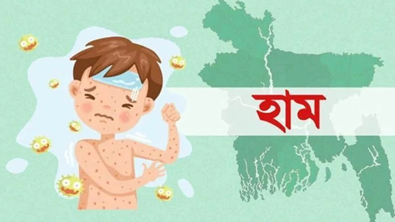 হাম ও হামের উপসর্গে আরও ৩ শিশুর মৃত্যু