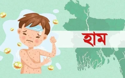 হামের উপসর্গে আরও ১১ শিশুর মৃত্যু